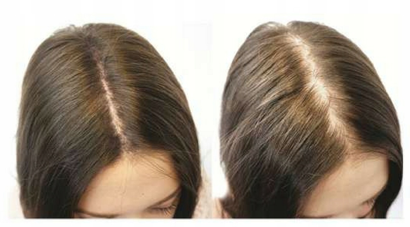 Treatment For Thinning Hair for Women - Foligain 10% Trioxidil from USA