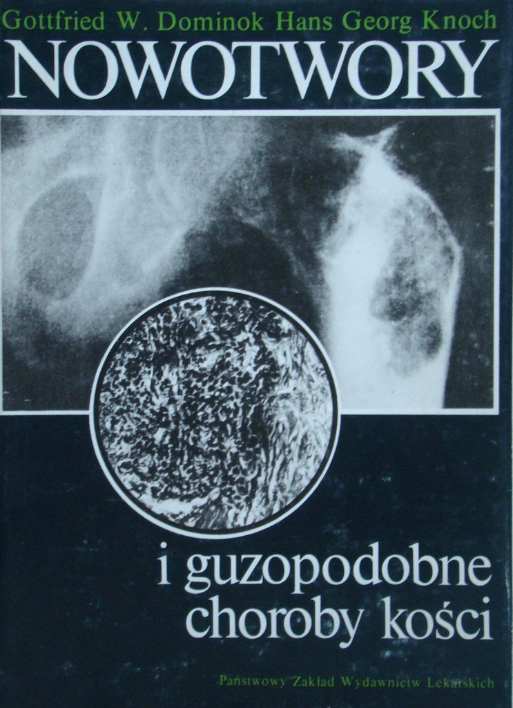 Dominok - Nowotwory i guzopodobne choroby kości
